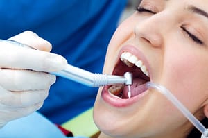 Profesyonel Diş Plağı Temizleme Yöntemleri ve Uzmanları