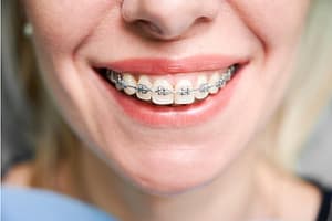 Ortodonti fiyatları Diş Teli Tedavi Maliyetleri