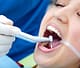 Profesyonel Diş Plağı Temizleme Yöntemleri ve Uzmanları