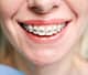 ortodonti-fiyatları