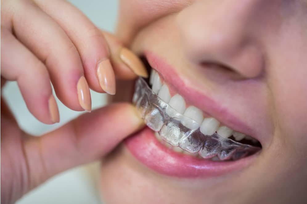Ortodontik tedavi ne kadar sürer?