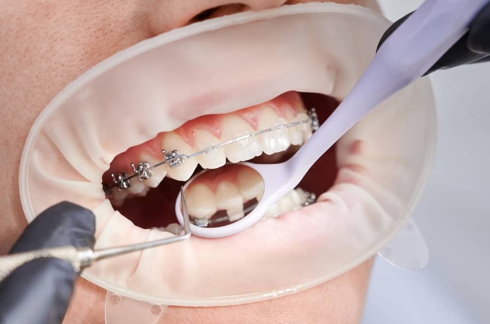 Ortodontide Üstün Sonuç ve Teknikler