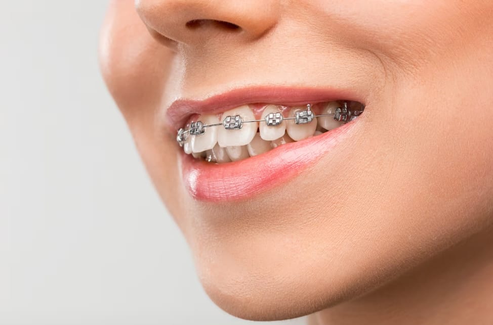 Dental Braces Price List The Most Suitable Options for Adults