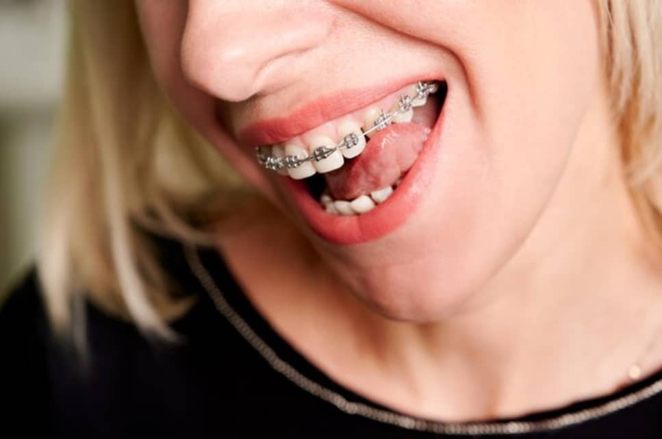 Ortodontik Tedavide Metal Braketlerin Kullanımı ve Etkinliği