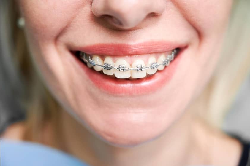 Ortodonti fiyatları Diş Teli Tedavi Maliyetleri
